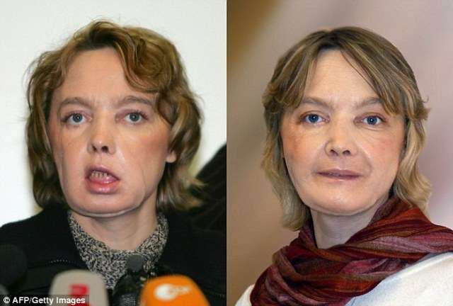 Vdes gruaja që bëri transplantin e parë të fytyrës në botë (FOTO)