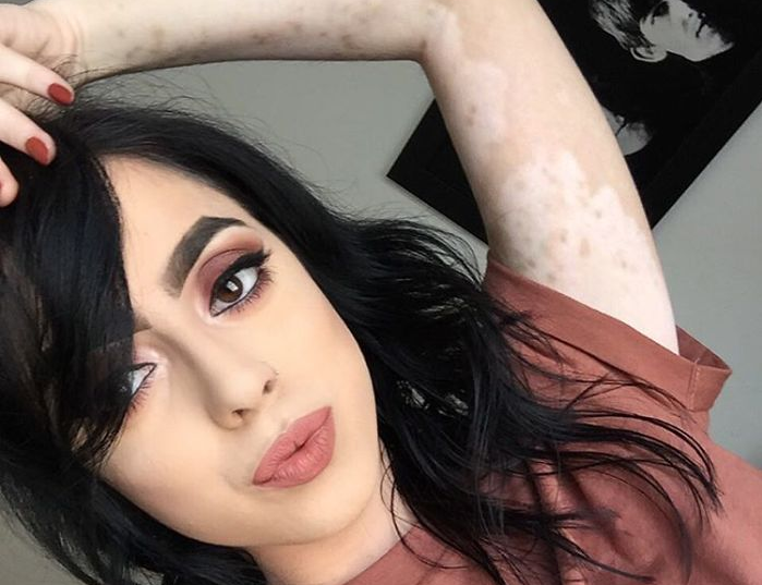 Vajza që shndërroi sëmundjen vitiligo në art (FOTO)