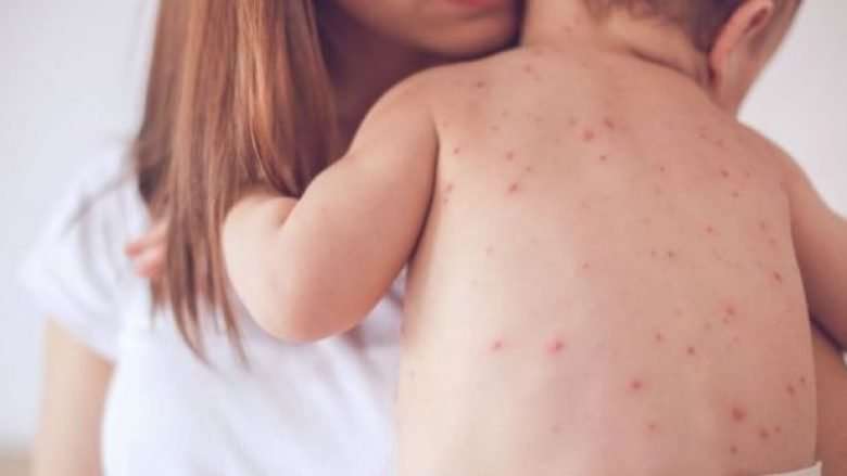 Vdes fëmija në QKUK, familja thotë se ndërroi jetë nga fruthi