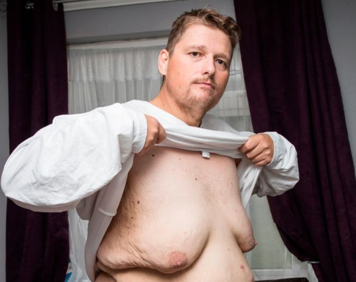 Peshonte 323 kg, humb gjysmën e peshës pasi mund të vdiste