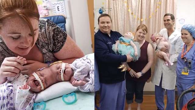 Ndahen me operacion kirurgjik binjakët që lindën të ngjitur në kokë (VIDEO)