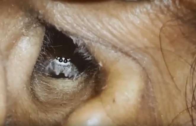 Merimanga e gjallë nxirret nga veshi i një gruaje (Video)