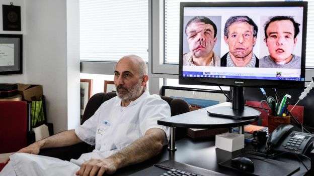 Ky është personi që transplantoi fytyrën tri herë (FOTO)