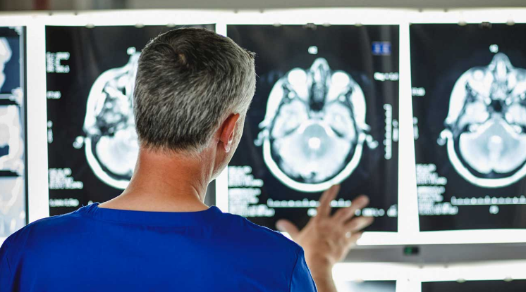 Hekuri i tepërt në tru, shkaktar potencial i Alzheimerit