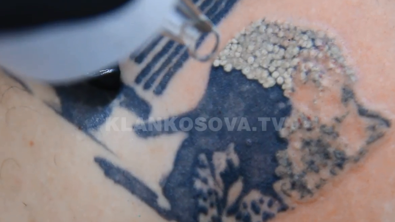 Si t’i eliminoni tatuazhet përmes laserit? (VIDEO)