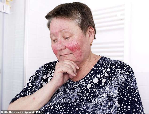 Kafja është e mirë për lëkurën, ul rrezikun për rosacea