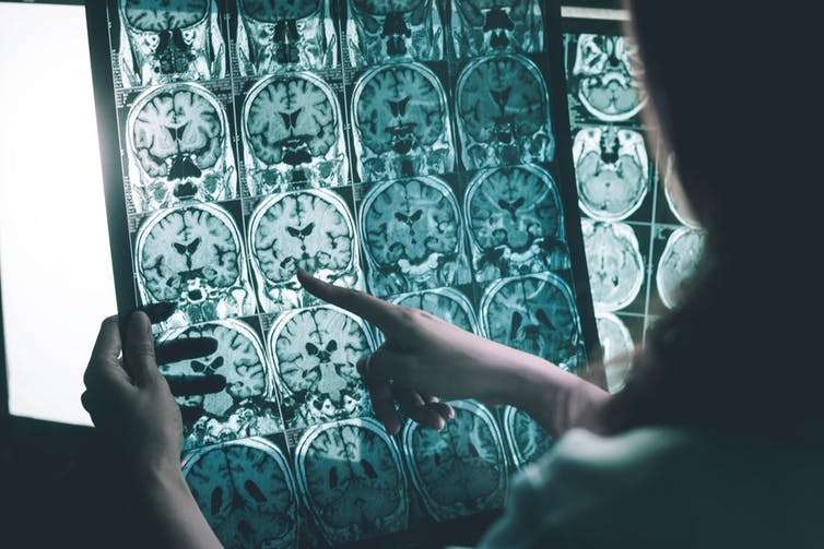 Herpesi mund të zhvillojë sëmundjen e Alzheimer 