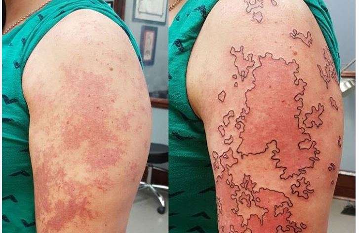 Tatuazhet zbukurojnë shenjat e padëshiruara në trup (FOTO)