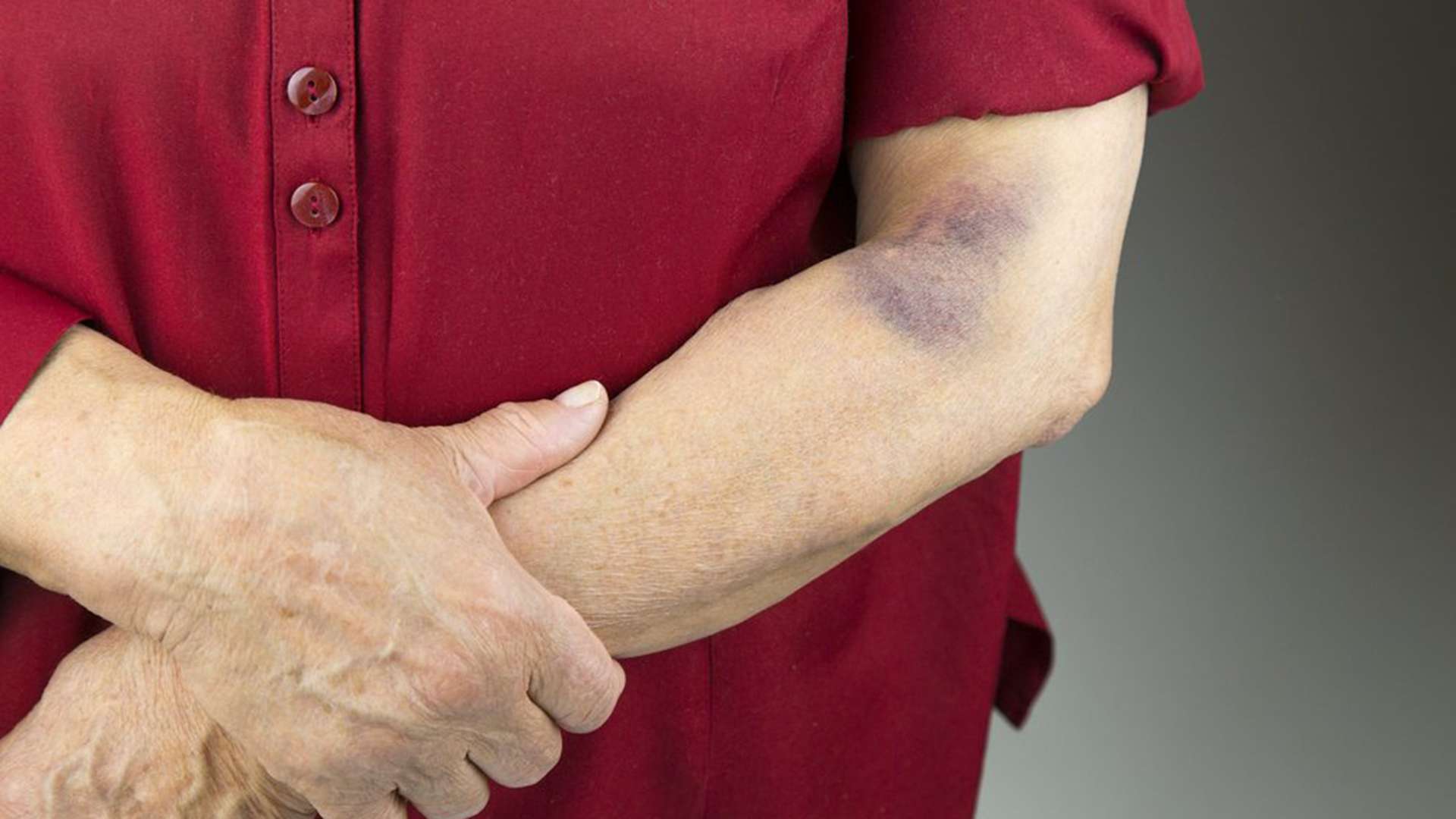 Arsyet pse shumë lehtë ju bëhen njollat e zeza në lëkurë