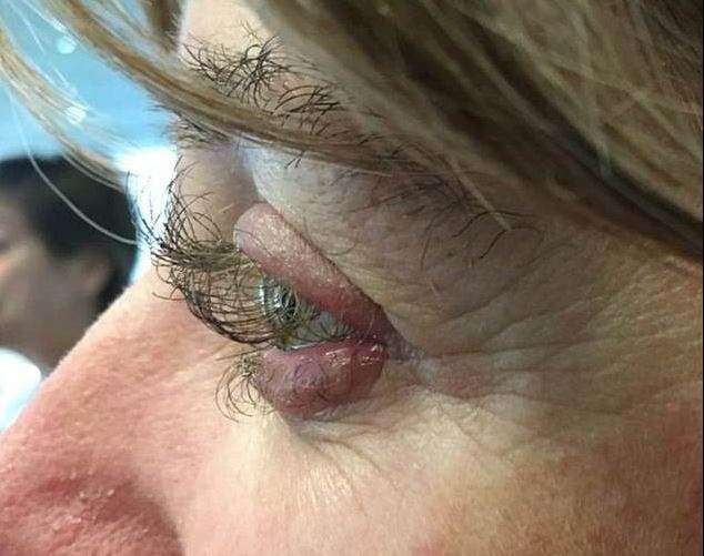 Rast i rrallë, gruaja bëhet me qerpikë 3 cm pas terapisë për kancer (FOTO)