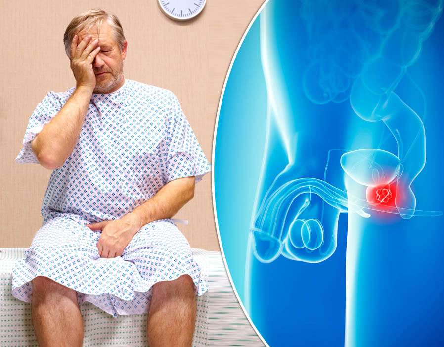 Kanceri i prostatës – simptoma seksuale që s’duhet injoruar