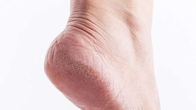 Si të trajtosh lëkurën e thatë të thembrave