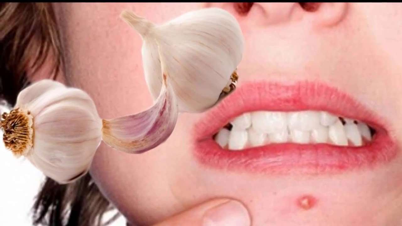 Shpëtoni nga puçrrat duke përdorur një ilaç të vetëm: Hudhrën!