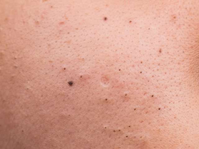 Maska më efektive me dy përbërës që pastron lëkurën në thellësi nga pikat e zeza