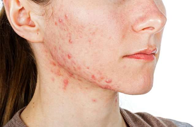 Shpëtoni nga puçrrat e kuqe në mjekër, këto janë mënyrat efikase nga dermatologët