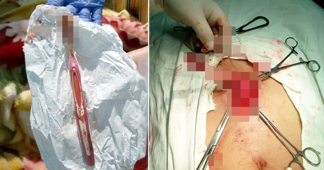 Gëlltiti furçën teksa lante dhëmbët, ia hoqën me operacion (FOTO)