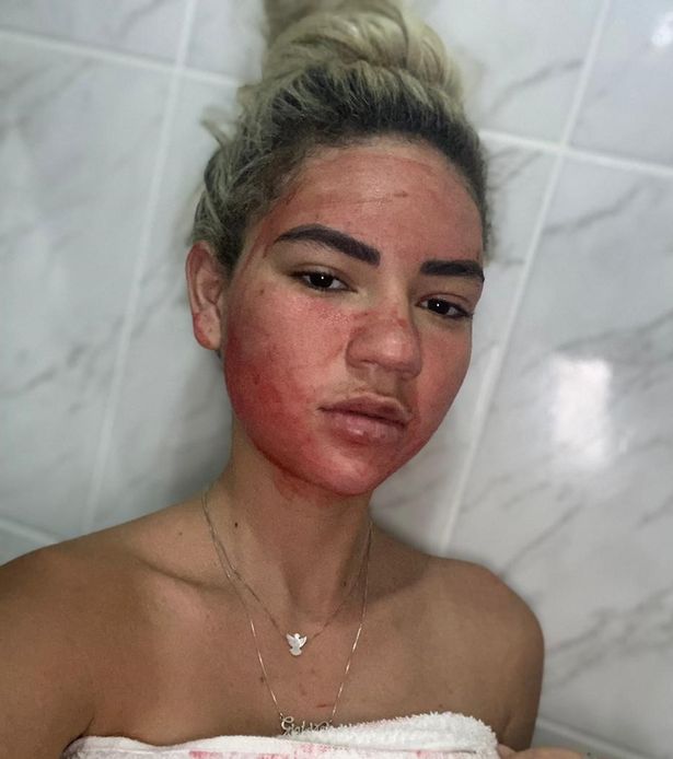 Influencerja përdorë gjakun e menstruacioneve për trajtimin e fytyrës
