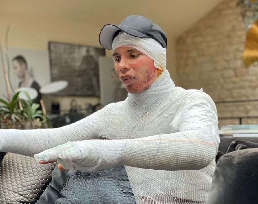 Një vit më vonë, krijuesi i “Balmain” zbulon se pësoi djegie të tmerrshme pas zjarrit në shtëpinë e tij