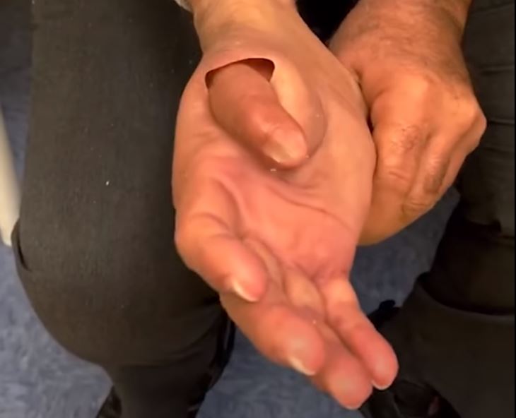 Protezat që duken si gishta të vërtetë (VIDEO)