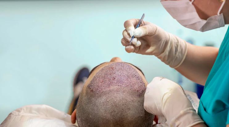 Keni planifikuar të mbillni flokët? Disa gjëra që duhet t’i dini për këtë proces