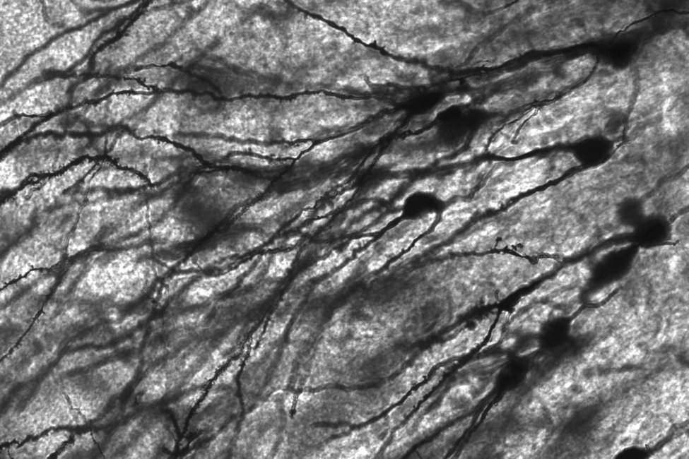 Studim: Qelizat 'zombi' në tru mund të shërbejnë për trajtimin e Alzheimer-it