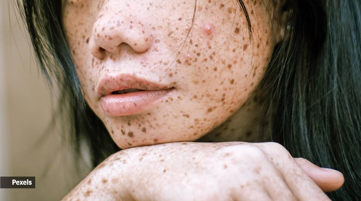 Çka është keratoza pilaris? Gjërat që duhet dhe s'duhet t'i bëni për të shmangur këtë problem