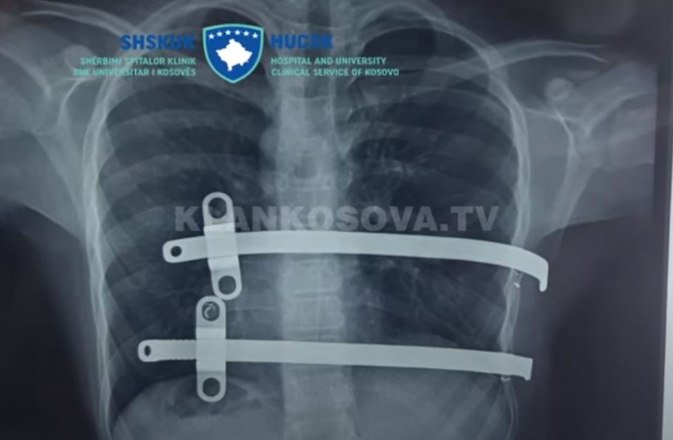 Operacion i rrallë në QKUK, hiqen pllakat e “gjoksit të lindur me defekt” (VIDEO)