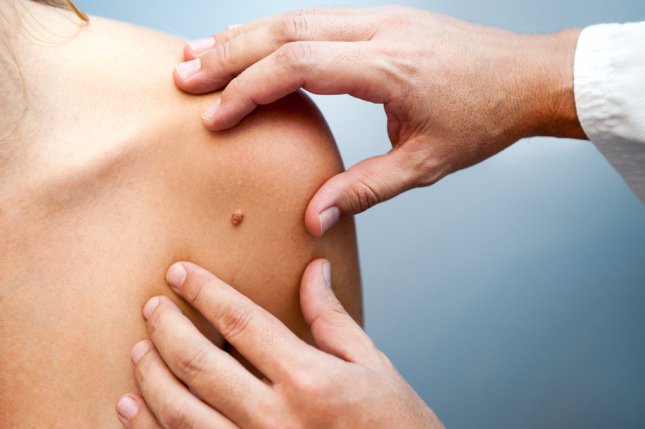 Testi i gjakut mund të diagnostikojë saktë melanomën, zbulon studimi