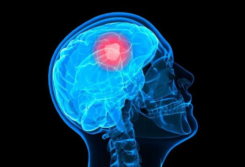 Çfarë është glioblastoma dhe cilat janë simptomat kryesore?