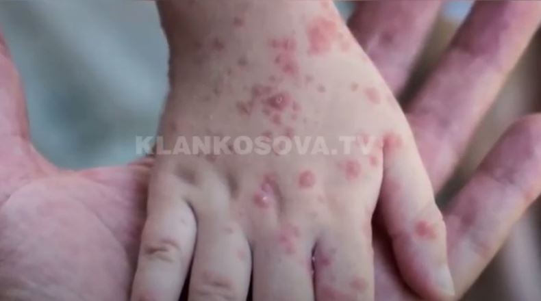 Lija e majmunëve, IKSHPK publikon informacione për virusin (VIDEO)
