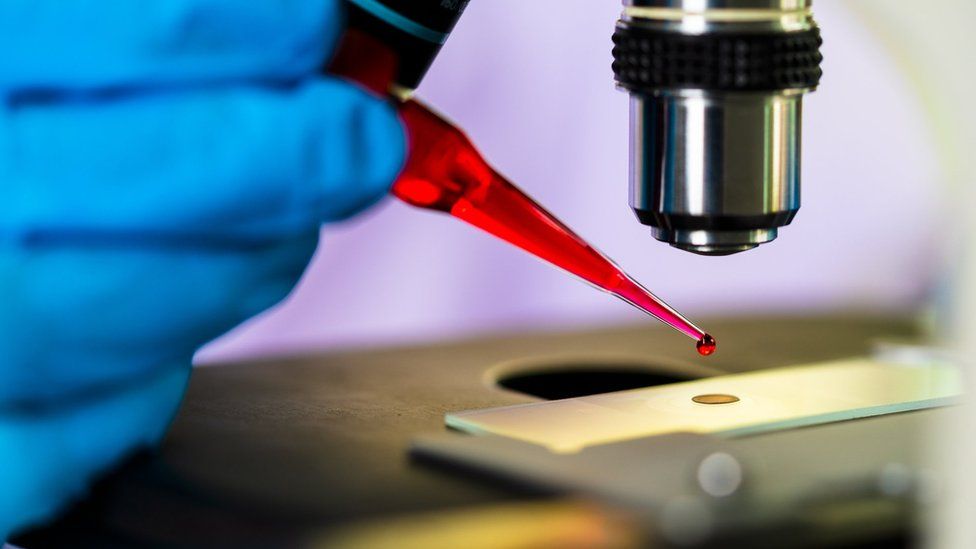 66 vjeçari bëhet pacienti i katërt në botë që shërohet nga HIV-i