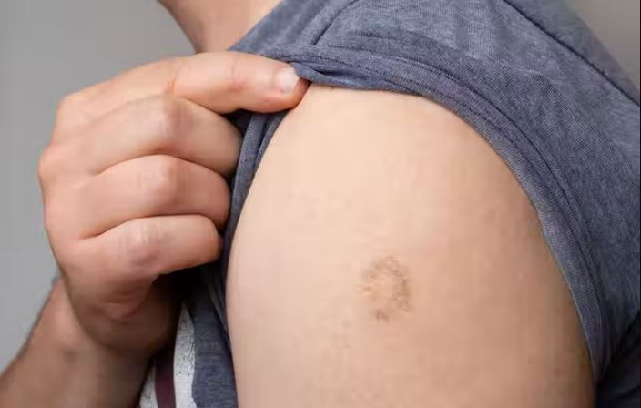 Burri që kishte tre muaj pa bërë seks diagnostifikohet me linë e majmunit