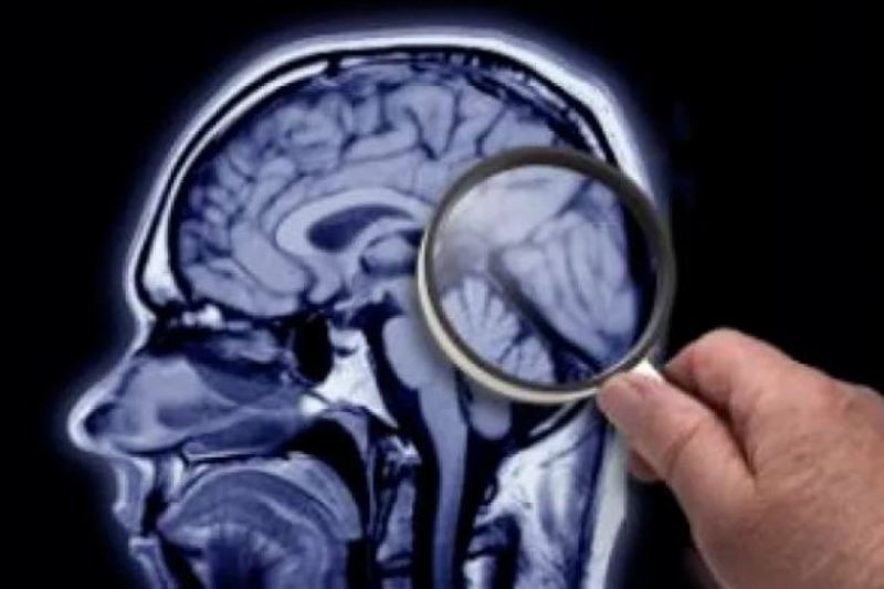 Cili është dallimi mes Alzheimerit dhe Demencës?