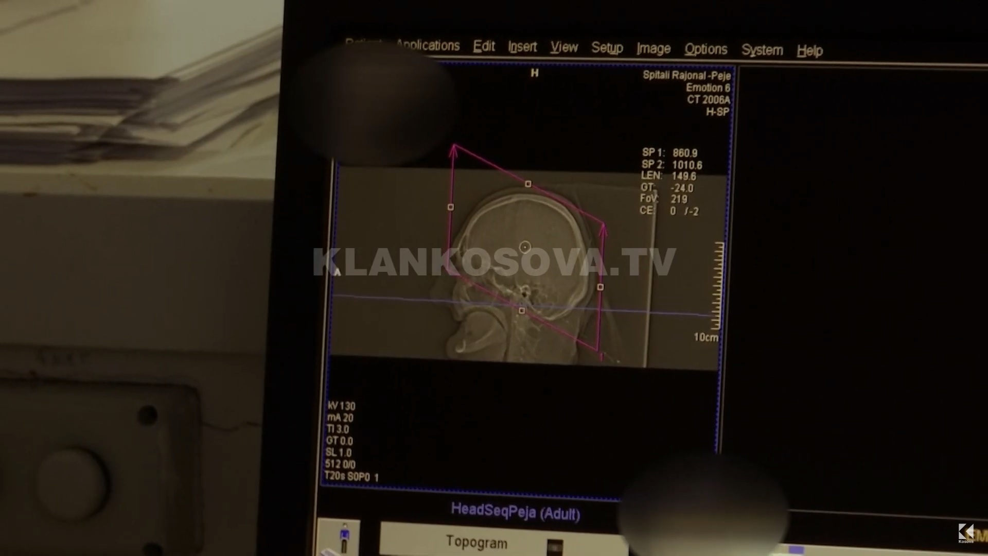 Spitali i Pejës bëhet me Rezonancë Magnetike, por ka veç dy radiologë (VIDEO)
