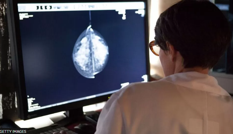 Inteligjenca artificiale jep premtime të mëdha për ekzaminimin e kancerit të gjirit