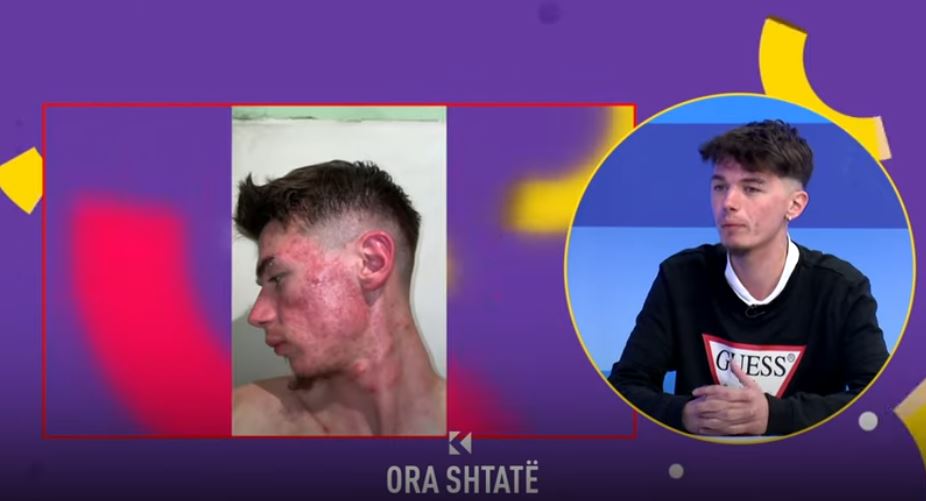 Djaloshi që i tejkaloi problemet me aknet, bullizimi i dha forcë për ndryshim! (VIDEO)