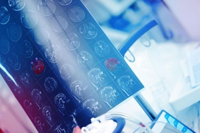 Pajisja me ultratinguj e implantuar në kafkë mund të ndihmojë në shenjëstrimin e tumoreve të trurit
