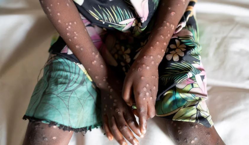 Vizitorët e Afrikës të konsiderojnë vaksinimin kundër Lijës së Majmunëve