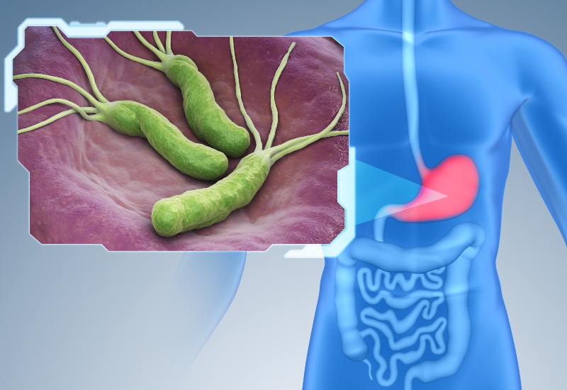 A keni H. pylori? Ja simptomat që mund të shfaqen