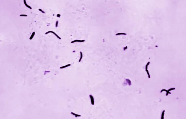 Tuberkulozi vrau 1 23 milion njerëz vitin e kaluar  thotë OBSH ja