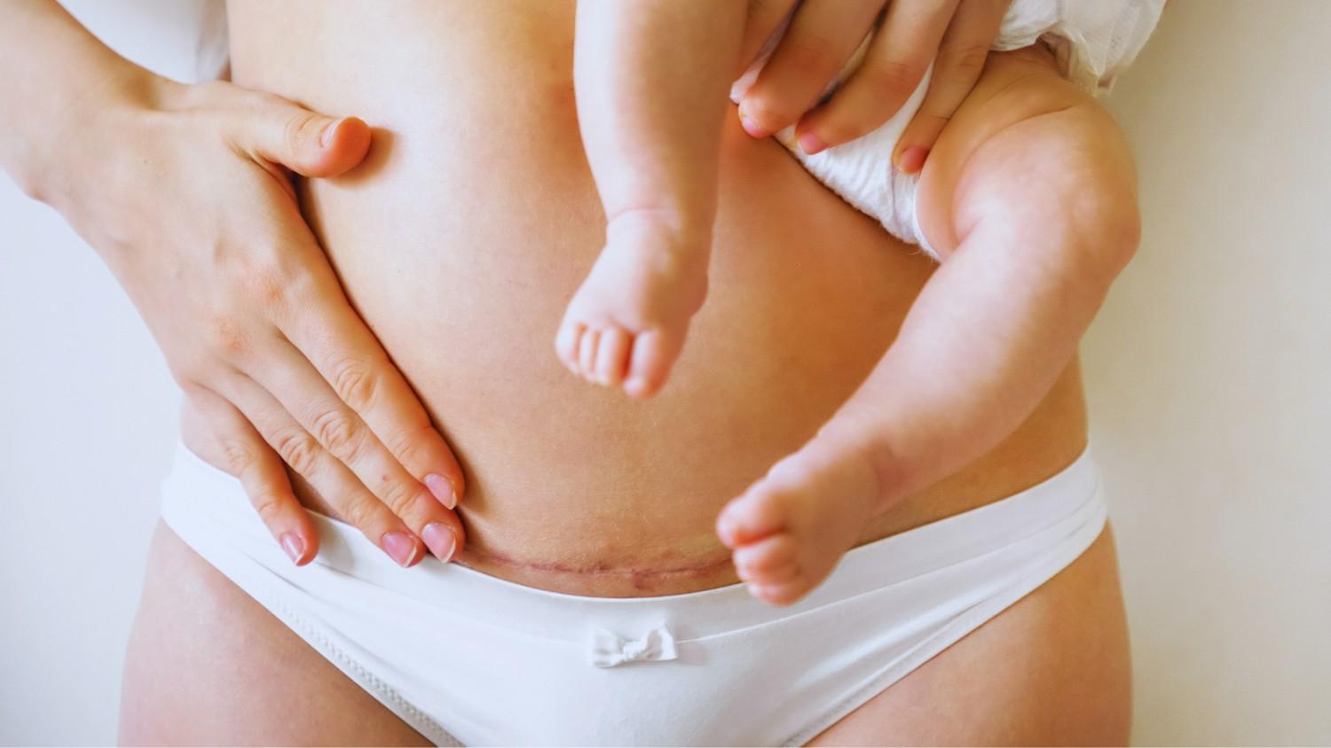  Traumat e natyrales  rrisin numrin e lindjeve cezariane